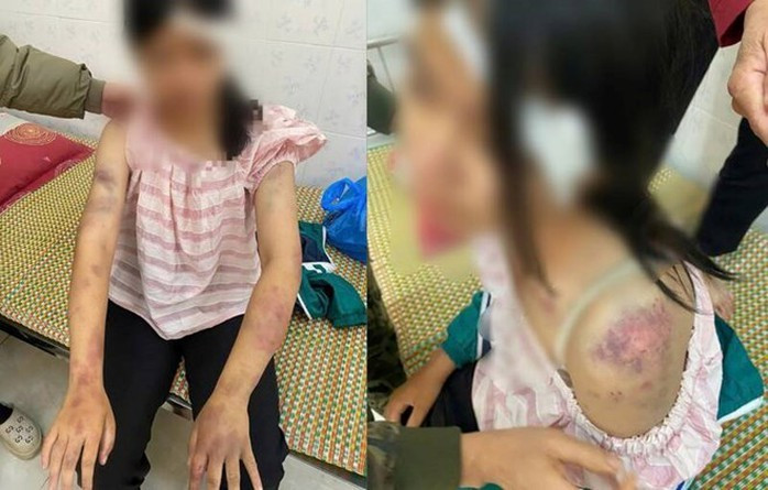 Cháu A. bị nhiều vết thương trên cơ thể. Ảnh: Công an cung cấp