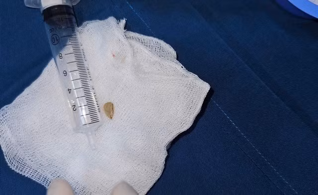 Hạt bí trong đường thở bé trai được gắp ra thành công. ẢNH: KIM NY