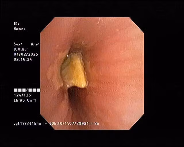 Qua nội soi, bác sĩ phát hiện hạt bí nằm trong đường thở bé trai. ẢNH: KIM NY