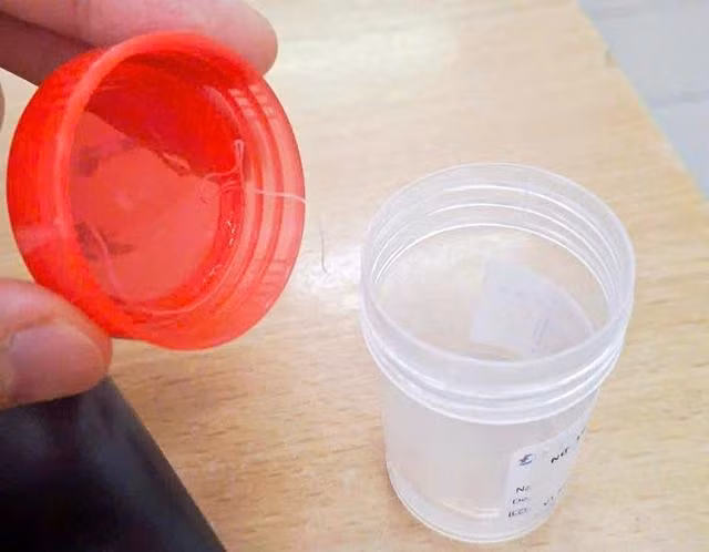 Ký sinh trùng chưa rõ tên gọi dài 10 cm được lấy ra từ mắt nữ bệnh nhân. ẢNH: THANH ĐẶNG