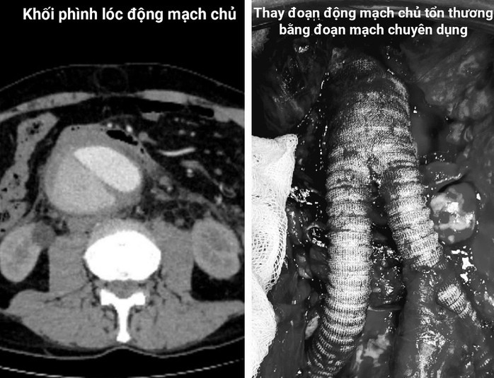 Bệnh nhân có tình trạng động mạch chủ ngực - bụng bị lóc tách kèm khối phình sắp vỡ Bệnh nhân có tình trạng động mạch chủ ngực - bụng bị lóc tách kèm khối phình sắp vỡ