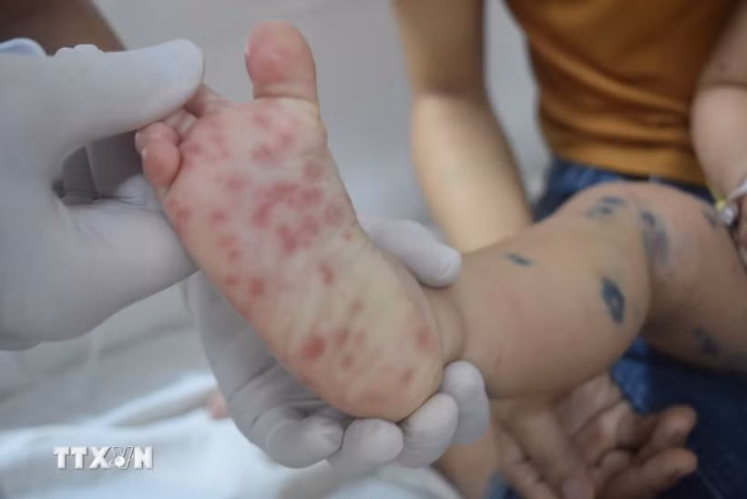Các nốt phát ban của bệnh nhi bị tay chân miệng. (Ảnh: TTXVN/Vietnam+)
