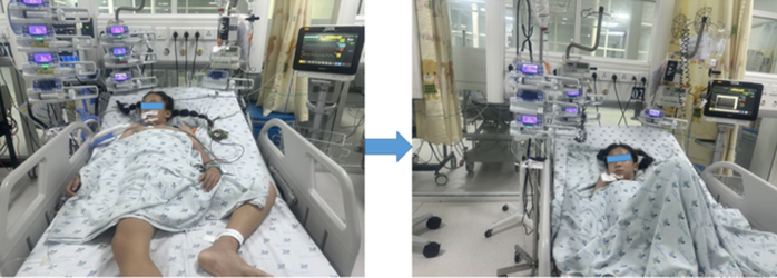 Bé gái mắc căn bệnh hiếm được các bác sĩ Bệnh viện Nhi Đồng Thành phố cứu sống