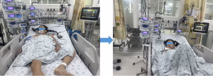 Bé gái mắc căn bệnh hiếm được các bác sĩ Bệnh viện Nhi Đồng Thành phố cứu sống