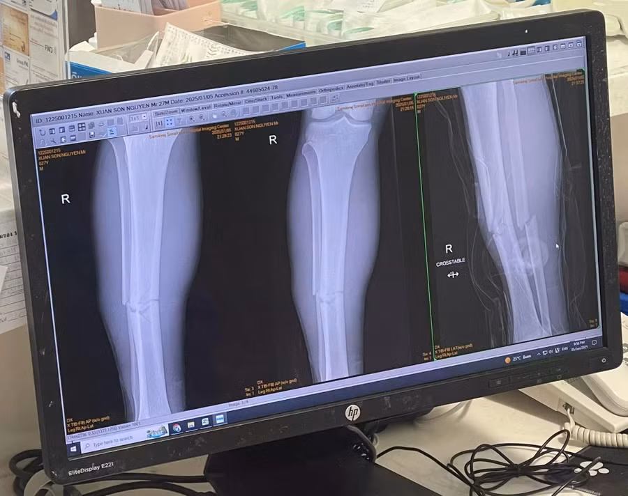 2 xương ống chân phải bị gãy của Xuân Son. Ảnh: Linh Nhi