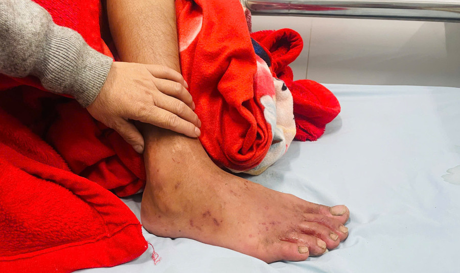 Trên chân anh Thắng có nhiều vết xước. Ảnh: N.T