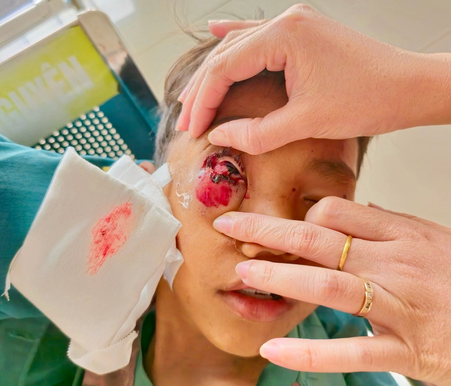 Một ca cấp cứu do pháo nổ tại Bệnh viện Mắt Cao Nguyên. Ảnh: Đơn vị cung cấp Một ca cấp cứu do pháo nổ tại Bệnh viện Mắt Cao Nguyên. Ảnh: Đơn vị cung cấp