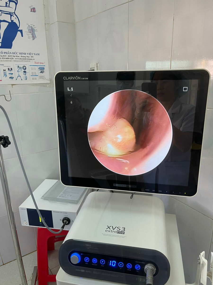 Hình ảnh chiếc răng trong mũi bệnh nhi. Ảnh: Bệnh viện Nhi cung cấp