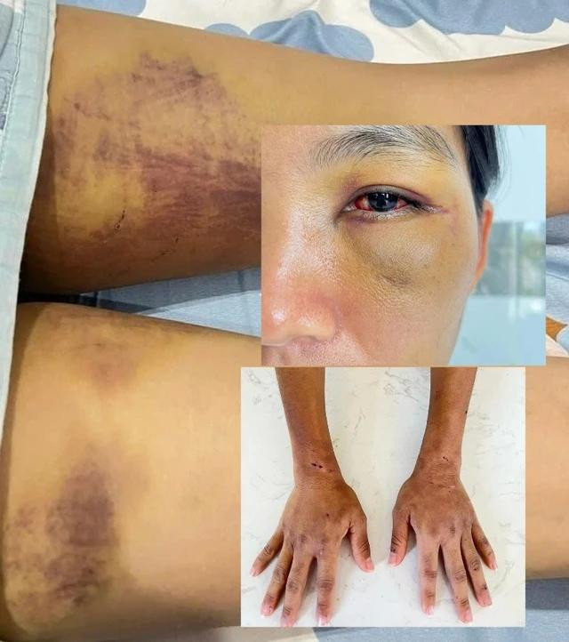 Cơ thể D. bị đánh đập tra tấn bầm dập Ảnh GĐCC Cơ thể D. bị đánh đập tra tấn bầm dập Ảnh GĐCC