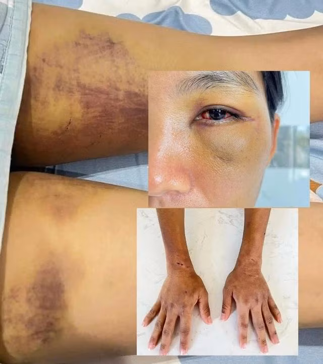 Cơ thể D. bị đánh đập tra tấn bầm dập Ảnh GĐCC