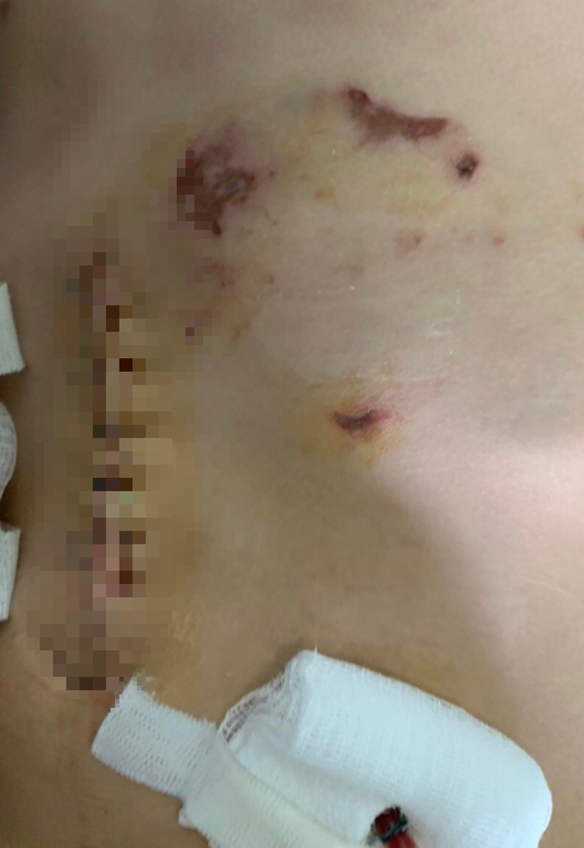 Vết thương bị chó cắn của bé B. sau khi được BVĐK khu vực An Giang phẫu thuật. Ảnh: BVCC Vết thương bị chó cắn của bé B. sau khi được BVĐK khu vực An Giang phẫu thuật. Ảnh: BVCC