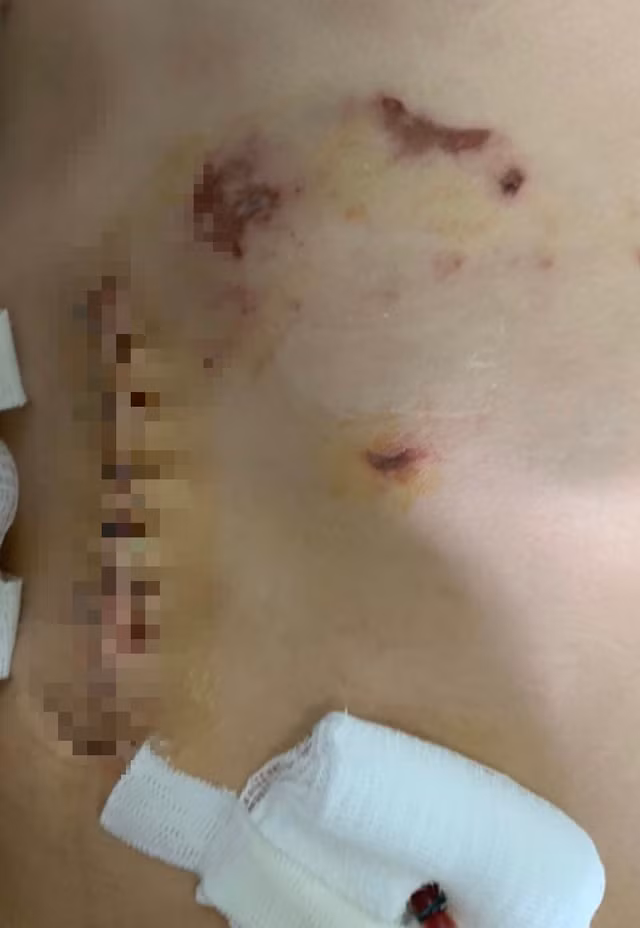 Vết thương bị chó cắn của bé B. sau khi được BVĐK khu vực An Giang phẫu thuật. Ảnh: BVCC