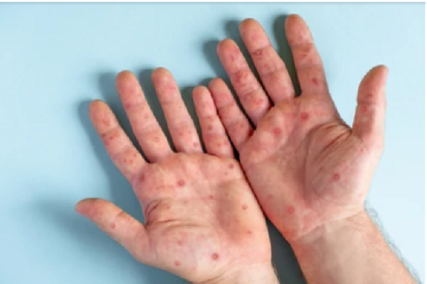Các nốt ban trên bàn tay người mắc đậu mùa khỉ. MINH HỌA: SHUTTERSTOCK