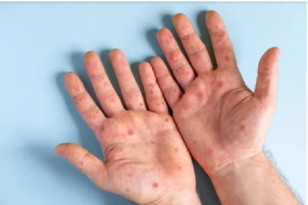 Các nốt ban trên bàn tay người mắc đậu mùa khỉ. MINH HỌA: SHUTTERSTOCK