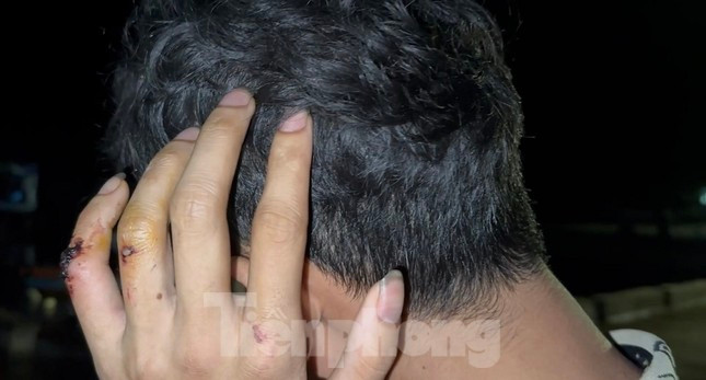 Hậu quả, khiến ngư dân Huỳnh Văn Hoanh (chủ tàu, máy trưởng) bị gãy tay phải và ngư dân Huỳnh Văn Tiến (thuyền trưởng) bị chấn thương vùng đầu. (Ảnh: Nguyễn Ngọc) Hậu quả, khiến ngư dân Huỳnh Văn Hoanh (chủ tàu, máy trưởng) bị gãy tay phải và ngư dân Huỳnh Văn Tiến (thuyền trưởng) bị chấn thương vùng đầu. (Ảnh: Nguyễn Ngọc)