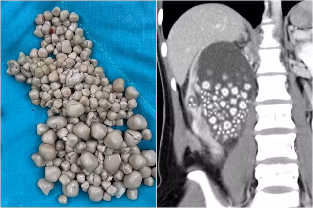 Hơn 300 sỏi thận được lấy ra bằng phẫu thuật ít xâm lấn. Ảnh: Trung tâm Y khoa Chi Mei