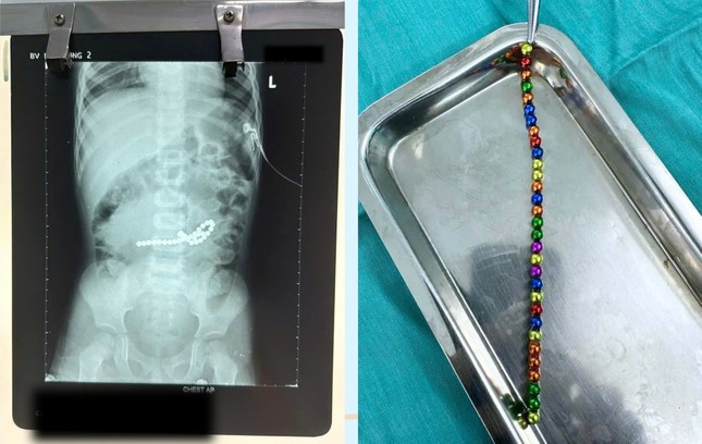 Các viên nam châm xếp hình trong đường tiêu hóa khiến trẻ bị thủng 8 lỗ ở ruột non