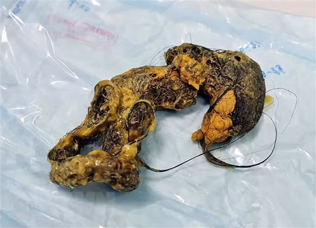 Búi tóc lấy trong bụng bé N. (Ảnh: TTXVN phát)