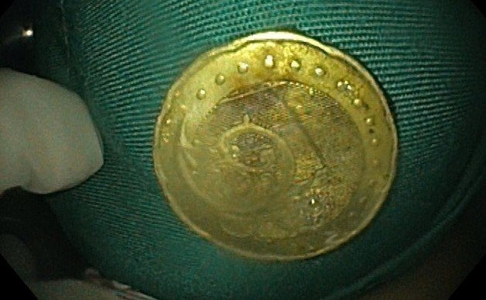 Gắp thành công đồng xu mắc kẹt trong thực quản của bé gái 5 tuổi - Ảnh 2. Đồng xu mắc kẹt trong thực quản của cháu A. được các bác sĩ gắp ra