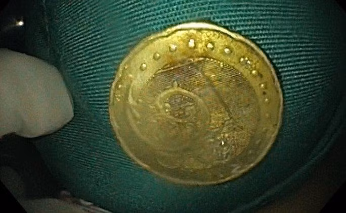 Đồng xu mắc kẹt trong thực quản của cháu A. được các bác sĩ gắp ra