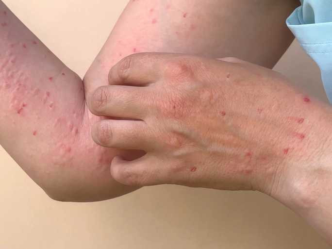 Bệnh đậu mùa khỉ có các triệu chứng chính là sốt, phát ban dạng phỏng nước