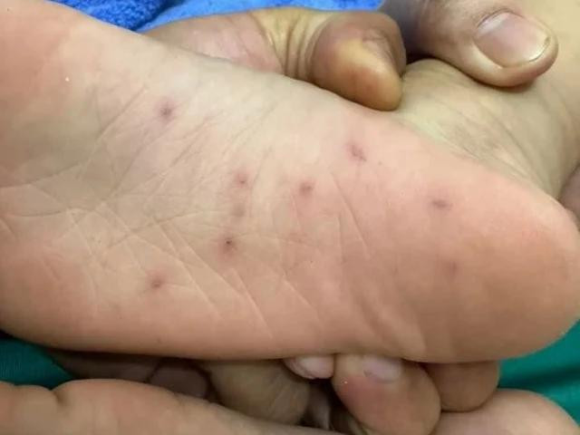 Bàn chân cháu H. có nhiều vết thương nghi do bị cô giáo dùng bút chì chọt vào Bàn chân cháu H. có nhiều vết thương nghi do bị cô giáo dùng bút chì chọt vào