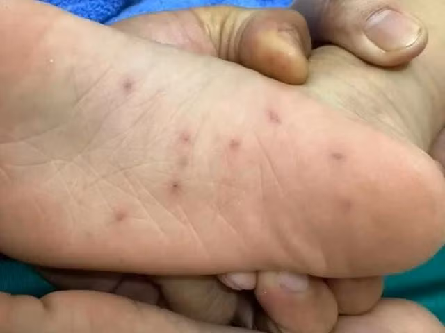 Bàn chân cháu H. có nhiều vết thương nghi do bị cô giáo dùng bút chì chọt vào