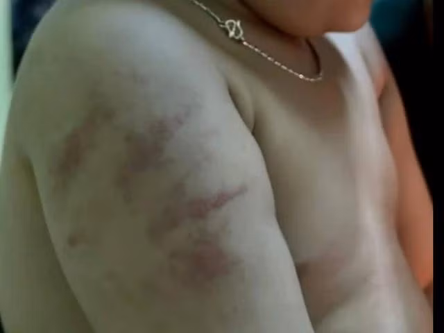 Bé trai ở H.Tuy Phước có nhiều vết thương trên cánh tay