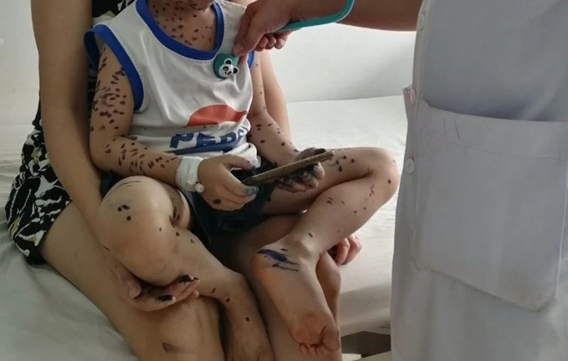 Nếu không phòng, chống dịch đúng cách, dịch thủy đậu sẽ lây lan nhanh trong cộng đồng. Nếu không phòng, chống dịch đúng cách, dịch thủy đậu sẽ lây lan nhanh trong cộng đồng.