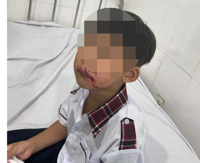 Chó béc-giê cắn 2 em học sinh tiểu học đứng trước cổng trường mắc bệnh dại - Ảnh 1. Em học sinh bị chó béc-giê cắn thương tích. Ảnh: CTV