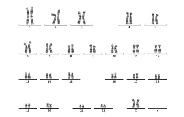 Nhiễm sắc thể đồ của bệnh nhân N. cho kết quả khảm 2 dòng tế bào. Trong ảnh là dòng tế bào 46,XX. Ảnh: S.X Nhiễm sắc thể đồ của bệnh nhân N. cho kết quả khảm 2 dòng tế bào. Trong ảnh là dòng tế bào 46,XX. Ảnh: S.X