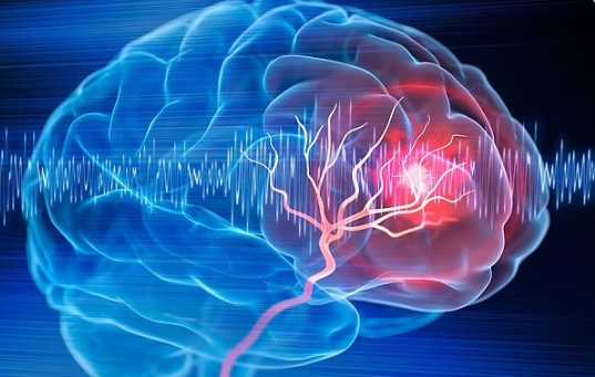 Dấu hiệu của đột quỵ có thể xuất hiện một tuần trước khi cấp cứu - Ảnh 1. Các dấu hiệu đột quỵ đầu tiên có thể xuất hiện vài ngày hoặc thậm chí một tuần trước khi xảy ra biến cố. Ảnh: Shutterstock