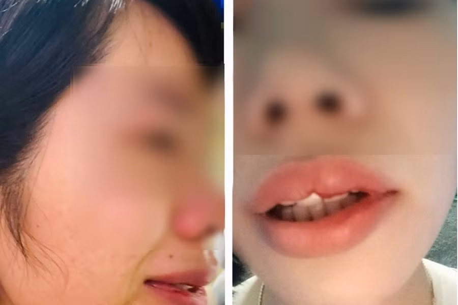 Nữ giáo viên bị hành hung với thương tích. Ảnh: Nhân vật cung cấp Nữ giáo viên bị hành hung với thương tích. Ảnh: Nhân vật cung cấp