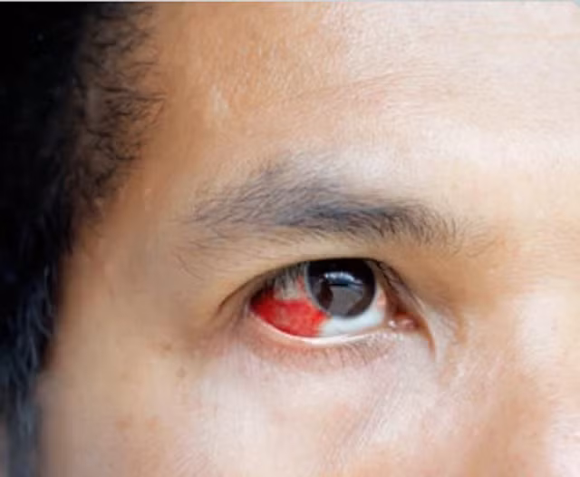 3 dấu hiệu bí mật của huyết áp cao - Ảnh 2. Đốm máu trong mắt thường gặp ở người bệnh tiểu đường hoặc huyết áp cao. Ảnh: Shutterstock