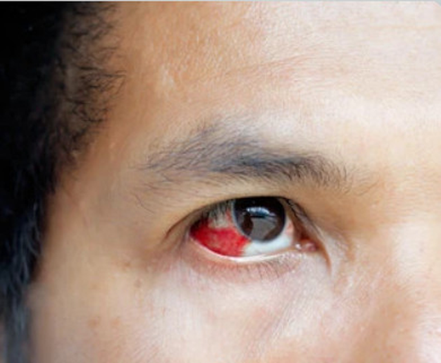 3 dấu hiệu bí mật của huyết áp cao - Ảnh 2. Đốm máu trong mắt thường gặp ở người bệnh tiểu đường hoặc huyết áp cao. Ảnh: Shutterstock