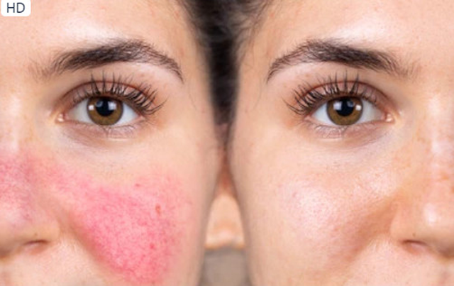 3 dấu hiệu bí mật của huyết áp cao - Ảnh 1. Đỏ bừng mặt xảy ra khi các mạch máu trên mặt giãn ra. Ảnh: Shutterstock