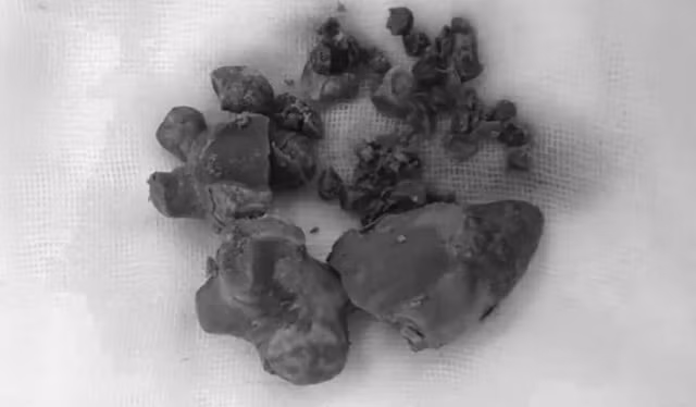 Sỏi san hô được bác sĩ lấy ra từ thận người đàn ông. Ảnh: ANH THƯ