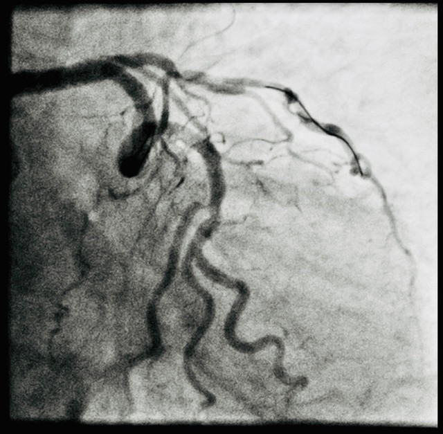 Hình ảnh mạch vành với tình trạng vôi hóa, tổn thương rất nhiều được can thiệp thành công. Ảnh: THÚY ANH Hình ảnh mạch vành với tình trạng vôi hóa, tổn thương rất nhiều được can thiệp thành công. Ảnh: THÚY ANH