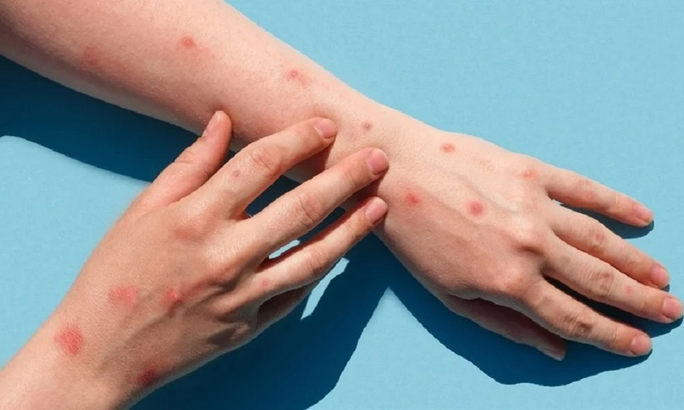 2 ca mắc đậu mùa khỉ, Bộ Y tế đề nghị xác định nguồn lây - Ảnh 1. Người bệnh đậu mùa khỉ có triệu chứng phát ban cấp tính