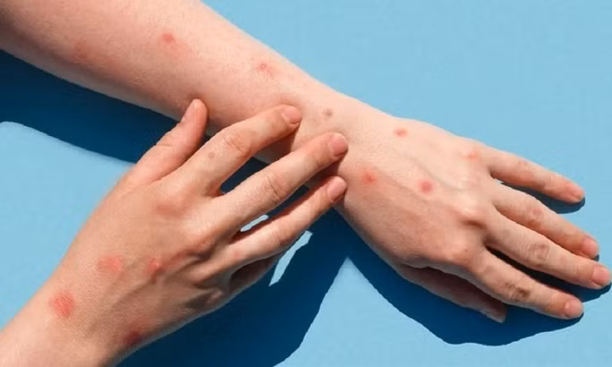 Người bệnh đậu mùa khỉ có triệu chứng phát ban cấp tính