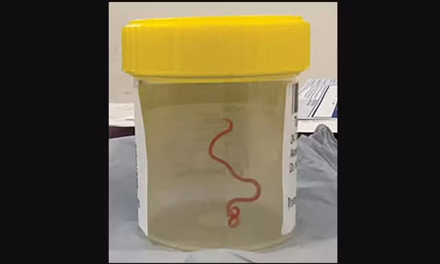 Con giun lấy ra từ não bệnh nhân. ẢNH CANBERRA HEALTH