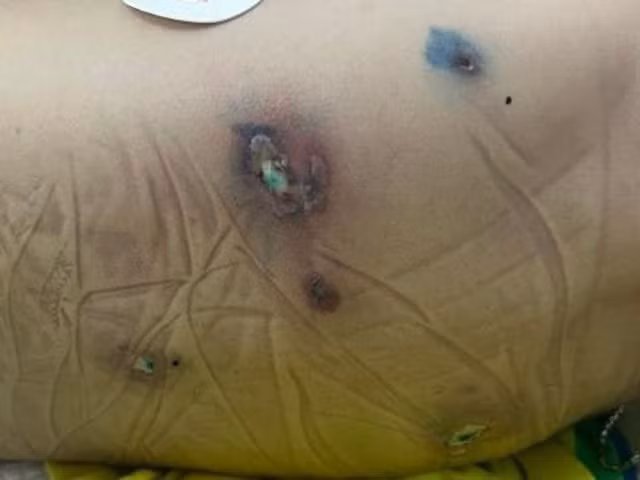 Hình ảnh tổn thương do vi khuẩn gây tiêu xương. Ảnh: Thanh Mai