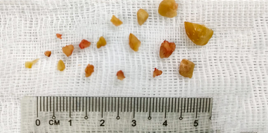 Hình ảnh hạt lạc mắc trong phế quản và được gắp ra ngoài sau khi phá thành nhiều mảnh nhỏ- Ảnh: Bệnh viện cung cấp