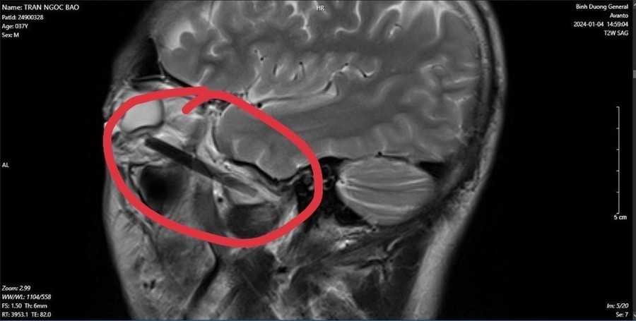 Hình ảnh dị vật trong mắt người đàn ông ở tỉnh Bình Dương. (Ảnh: TTXVN phát) Hình ảnh dị vật trong mắt người đàn ông ở tỉnh Bình Dương. (Ảnh: TTXVN phát)