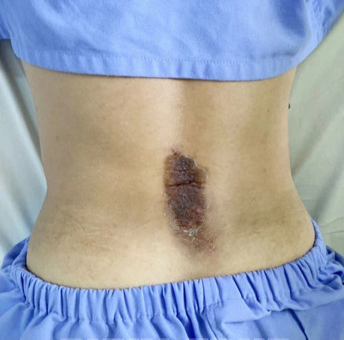 Vết bỏng da của nam bệnh nhân vì tự ý đắp thuốc trị đau lưng. Ảnh: BVCC