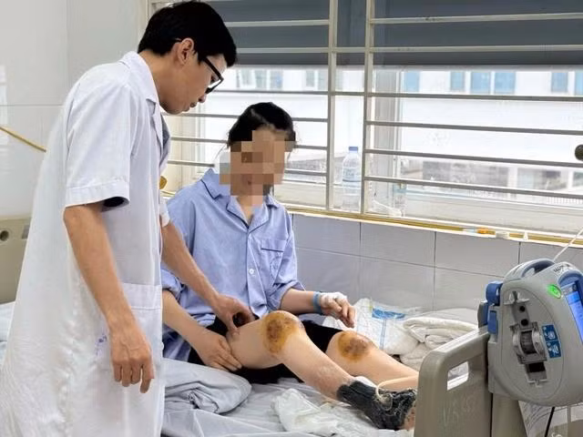 Các bác sĩ điều trị cho nữ bệnh nhân biến dạng khớp gối, hoại tử bàn chân sau khi dùng ong đốt để điều trị viêm khớp.