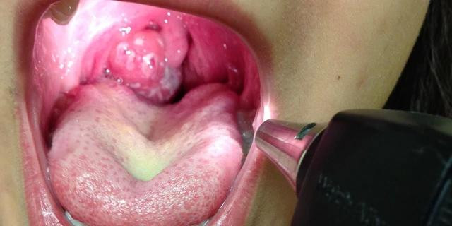 Đau họng là một trong những triệu chứng điển hình của bệnh bạch hầu Đau họng là một trong những triệu chứng điển hình của bệnh bạch hầu