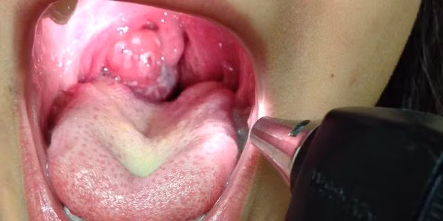 Đau họng là một trong những triệu chứng điển hình của bệnh bạch hầu