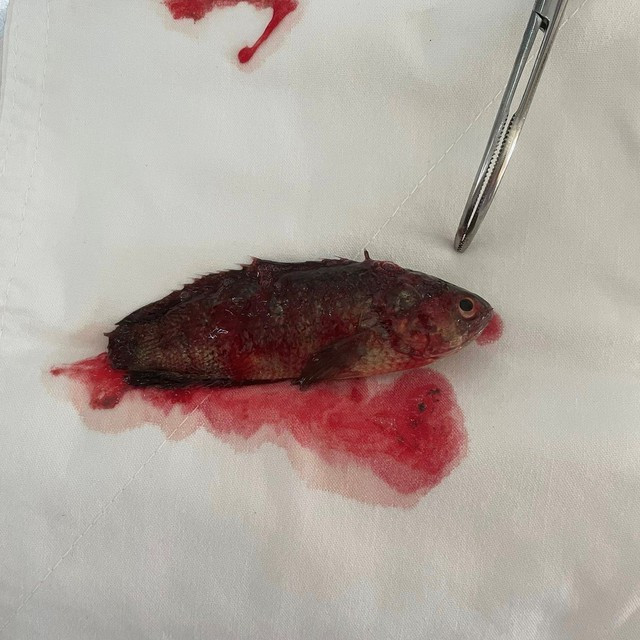 Dị vật là con cá rô gây tổn thương cổ họng nặng bệnh nhân. ẢNH TRUNG TÂM Y TẾ H.GIỒNG RIỀNG CUNG CẤP Dị vật là con cá rô gây tổn thương cổ họng nặng bệnh nhân. ẢNH TRUNG TÂM Y TẾ H.GIỒNG RIỀNG CUNG CẤP