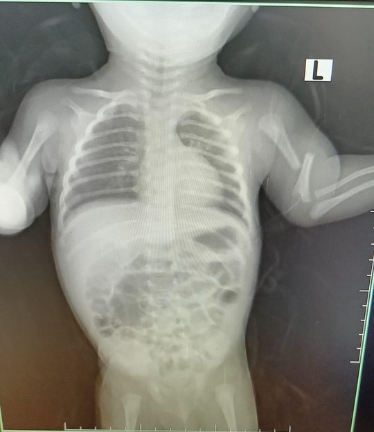 Bắt khẩn cấp nghi phạm bạo hành khiến bé 3 tháng tuổi tử vong - Ảnh 2. Ảnh chụp phim cho thấy xương tay cháu bé gãy nhiều phần.